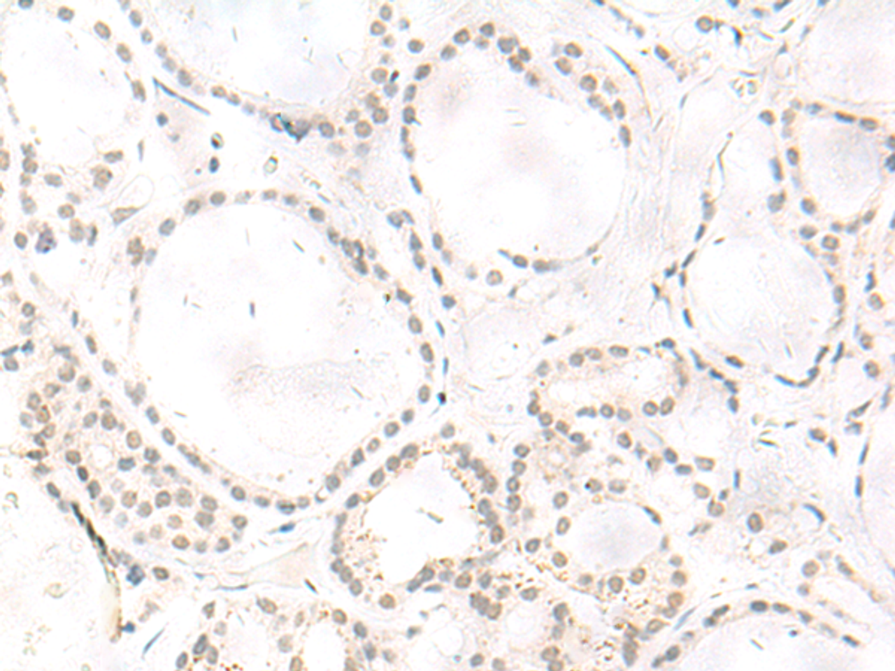 Immunohistochemistry of paraffin-embedded Human thyroid cancer tissue  using ARL2BP Polyclonal Antibody at dilution of 1:50(×200)