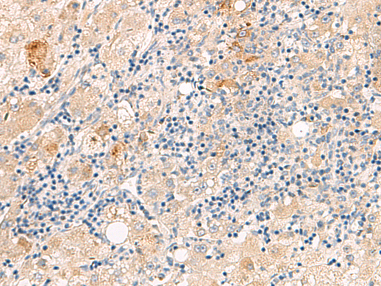 Immunohistochemistry of paraffin-embedded Human liver cancer tissue  using THNSL1 Polyclonal Antibody at dilution of 1:70(×200)