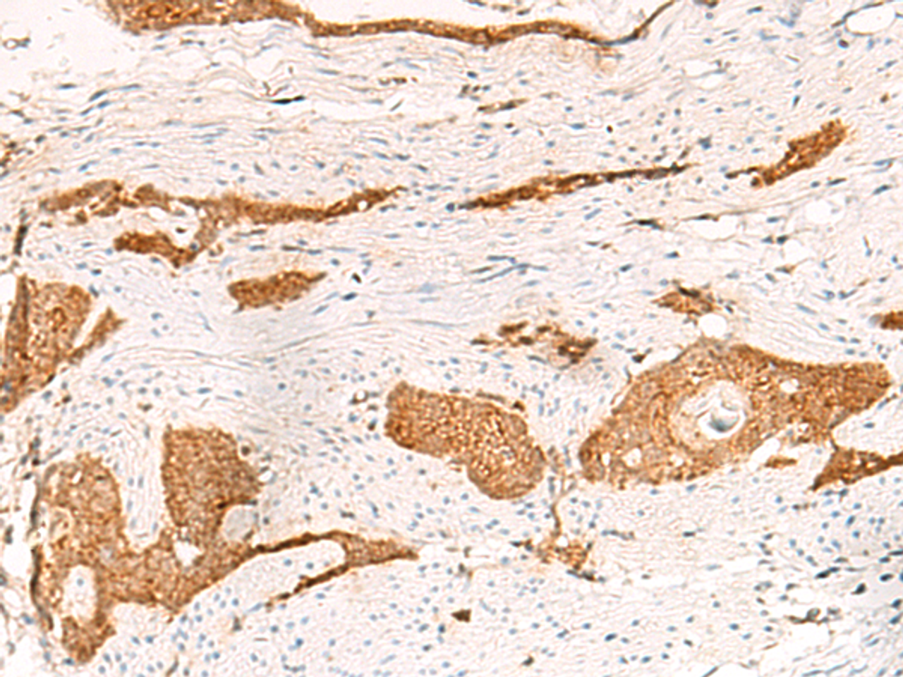 Immunohistochemistry of paraffin-embedded Human esophagus cancer tissue  using THNSL1 Polyclonal Antibody at dilution of 1:70(×200)