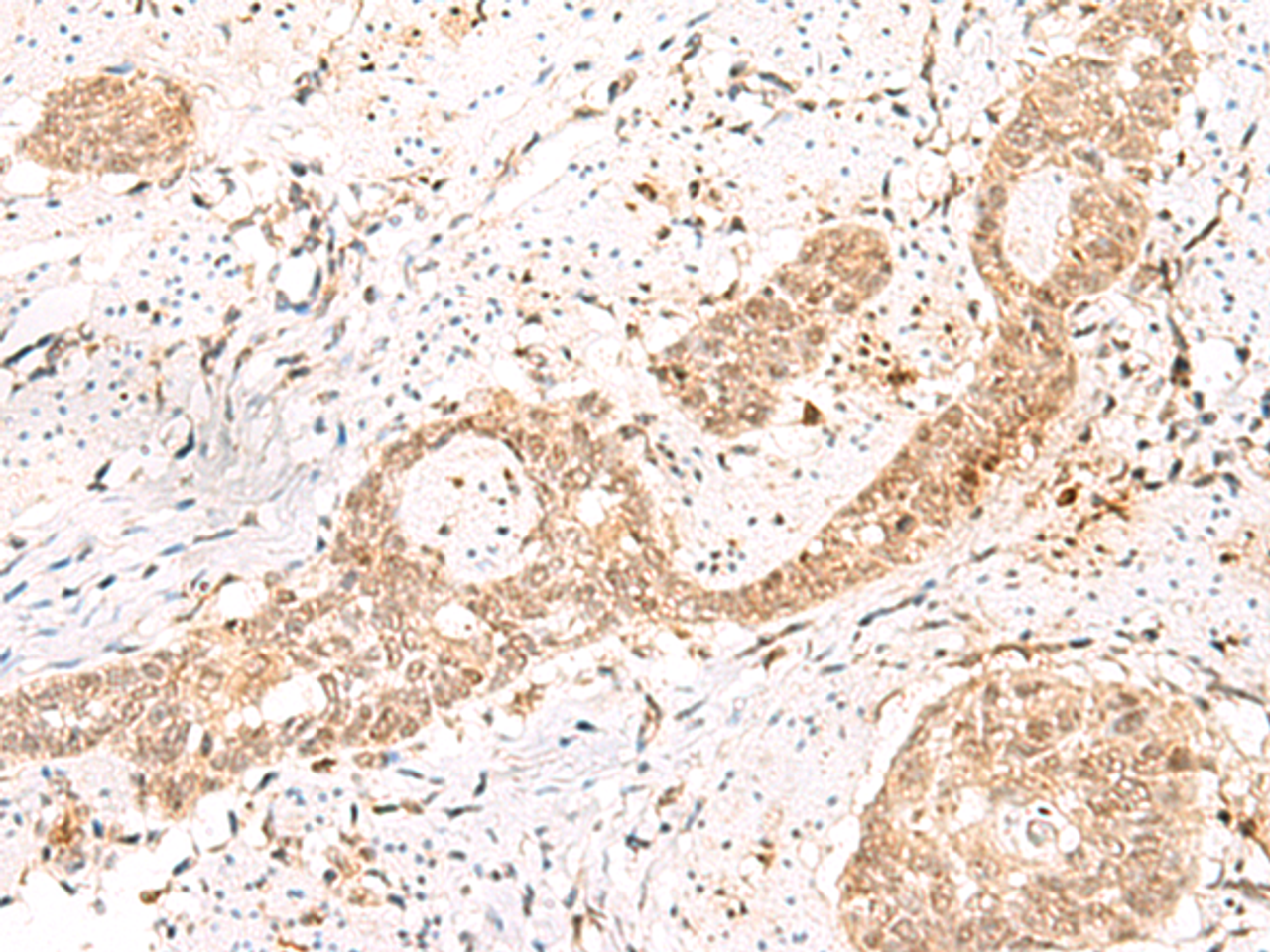 Immunohistochemistry of paraffin-embedded Human esophagus cancer tissue  using PRKAG2 Polyclonal Antibody at dilution of 1:55(×200)