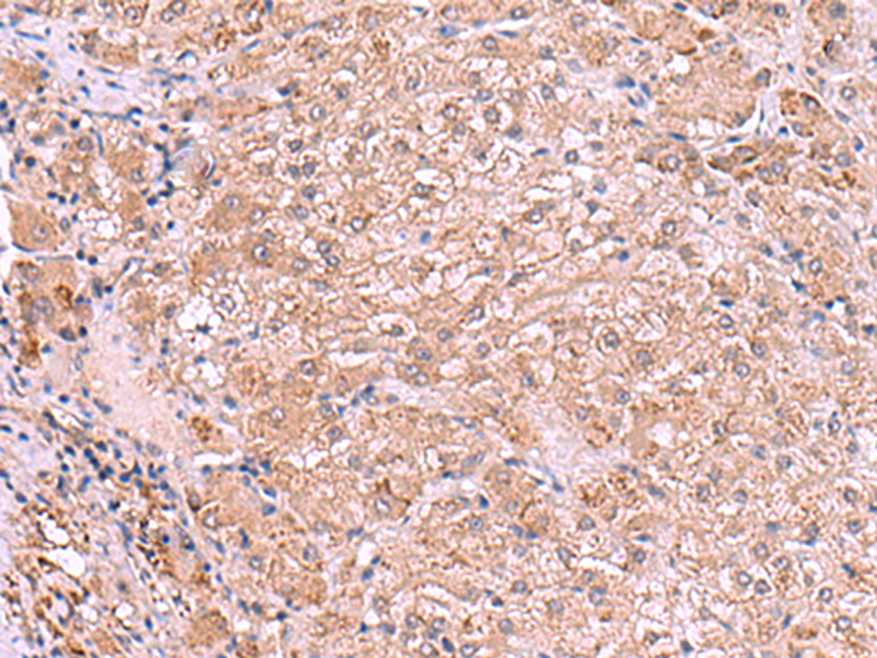Immunohistochemistry of paraffin-embedded Human liver cancer tissue  using RIC3 Polyclonal Antibody at dilution of 1:90(×200)