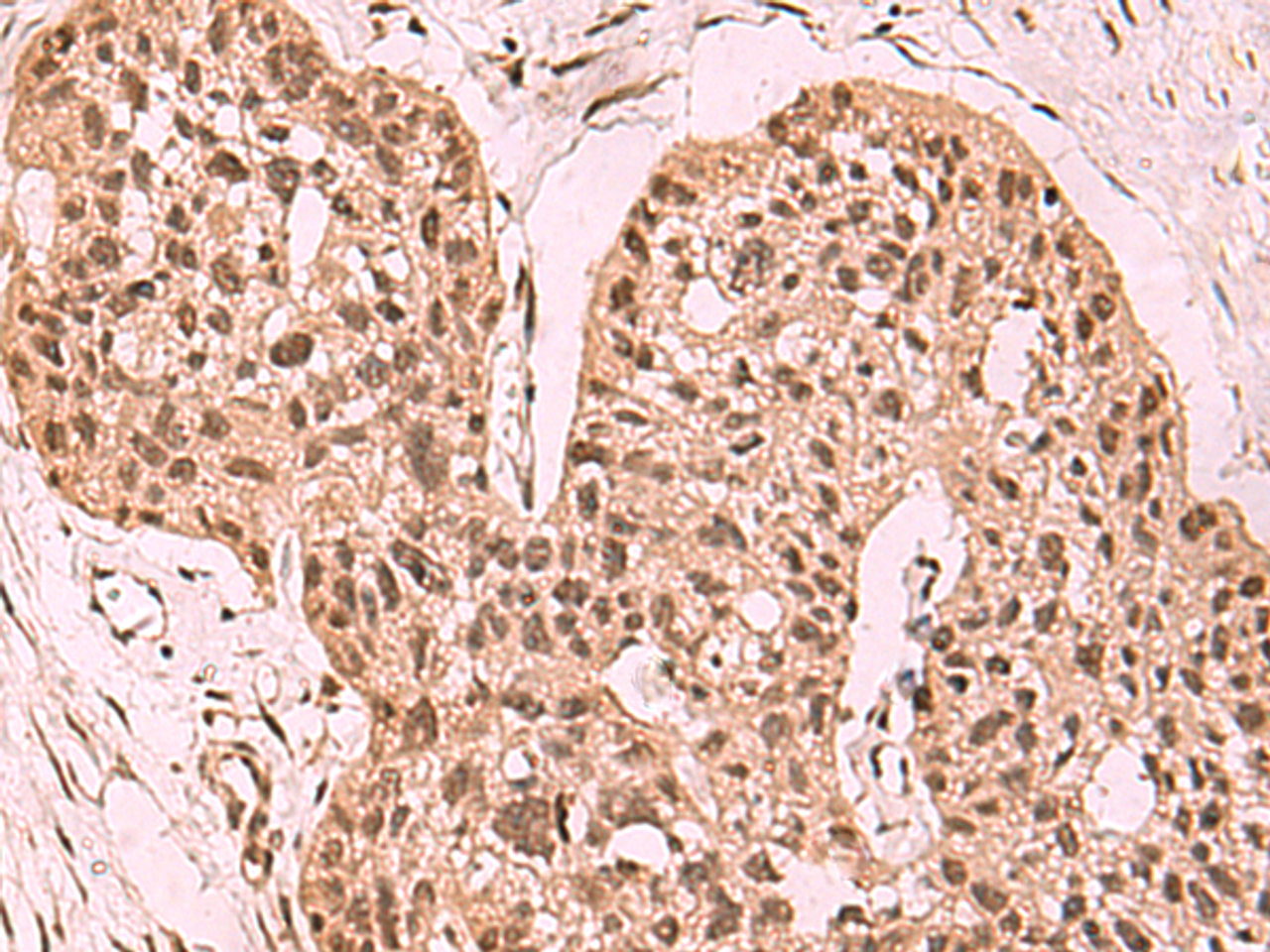 Immunohistochemistry of paraffin-embedded Human esophagus cancer tissue  using SETDB1 Polyclonal Antibody at dilution of 1:60(×200)