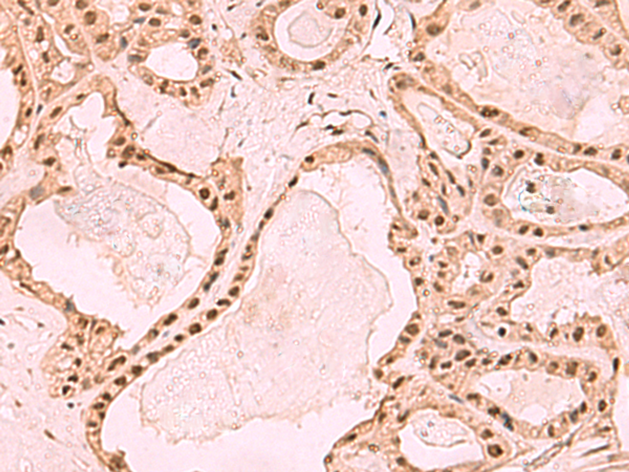 Immunohistochemistry of paraffin-embedded Human thyroid cancer tissue  using SETDB1 Polyclonal Antibody at dilution of 1:60(×200)