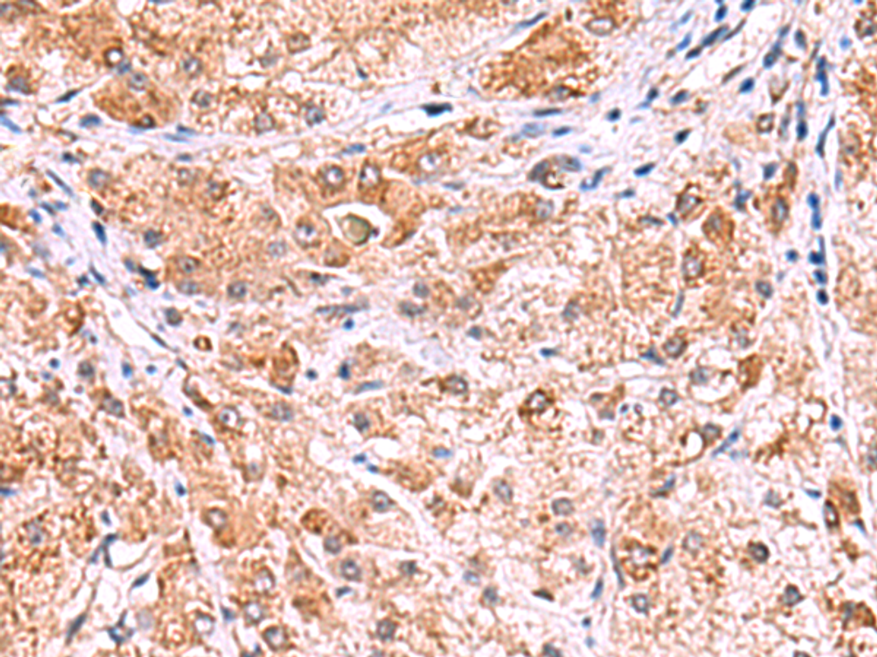 Immunohistochemistry of paraffin-embedded Human liver cancer tissue  using UXS1 Polyclonal Antibody at dilution of 1:60(×200)