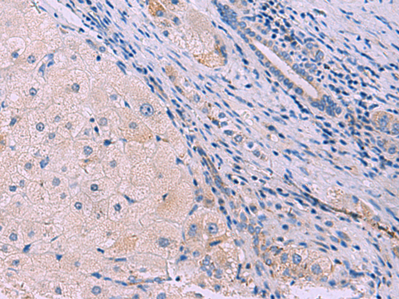 Immunohistochemistry of paraffin-embedded Human liver cancer tissue  using SIGLEC6 Polyclonal Antibody at dilution of 1:50(×200)