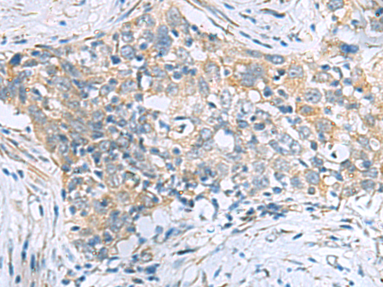 Immunohistochemistry of paraffin-embedded Human esophagus cancer tissue  using PPIC Polyclonal Antibody at dilution of 1:50(×200)