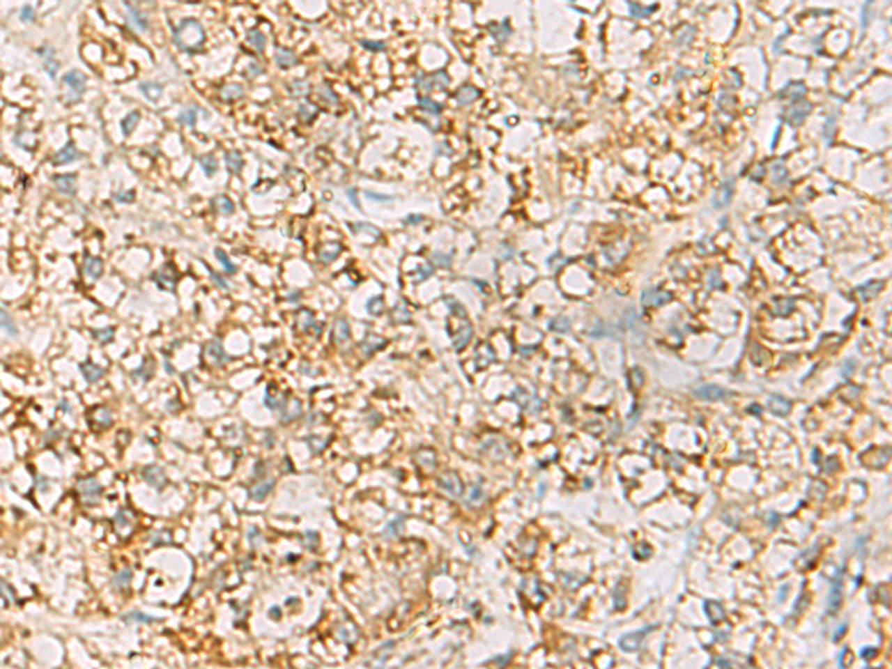 Immunohistochemistry of paraffin-embedded Human liver cancer tissue  using HLA-DQB2 Polyclonal Antibody at dilution of 1:70(×200)