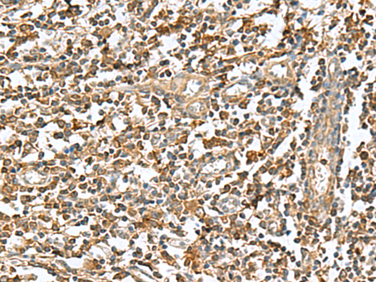 Immunohistochemistry of paraffin-embedded Human tonsil tissue  using RAB23 Polyclonal Antibody at dilution of 1:50(×200)