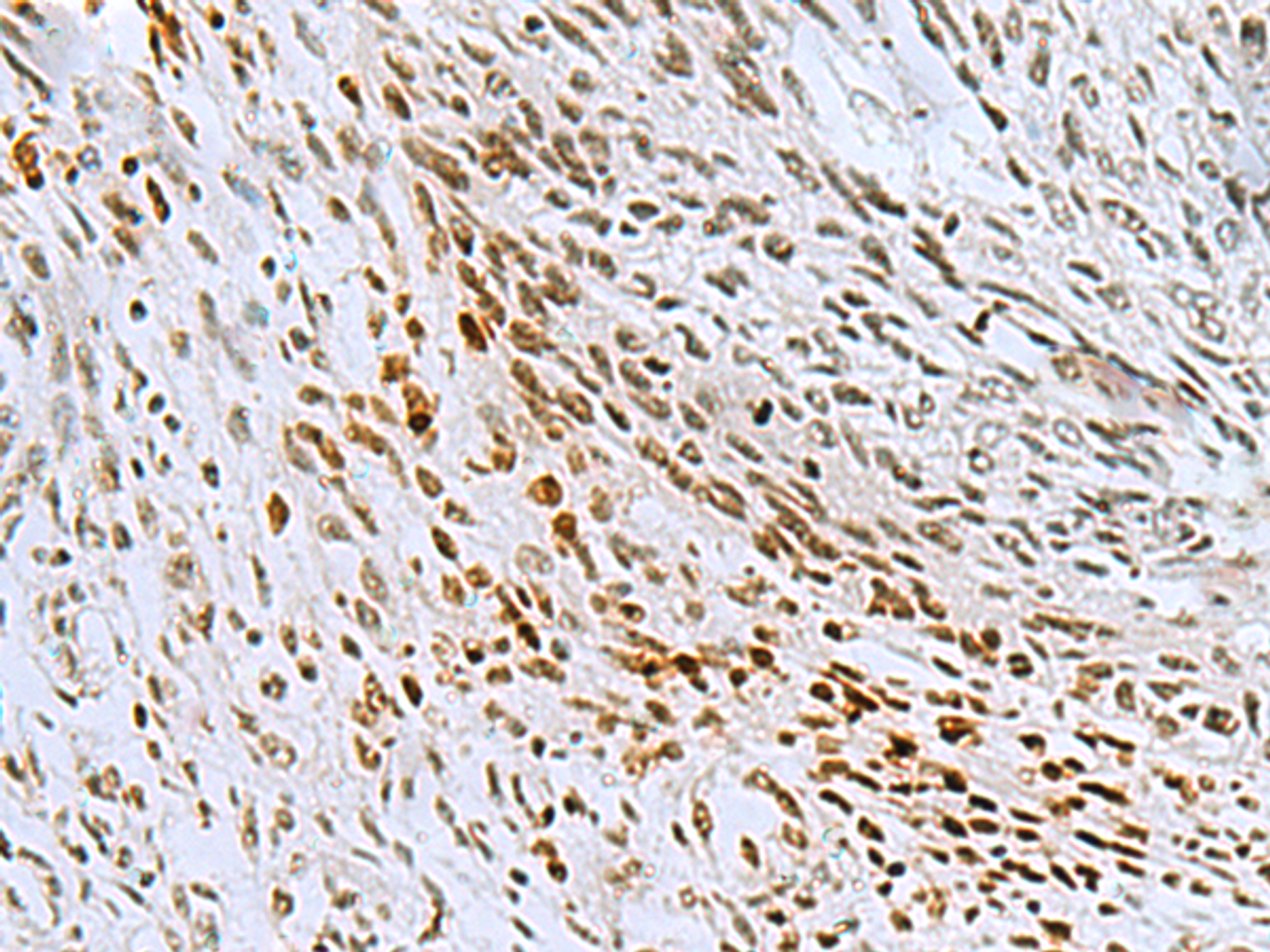 Immunohistochemistry of paraffin-embedded Human lung cancer tissue  using CNOT7 Polyclonal Antibody at dilution of 1:55(×200)