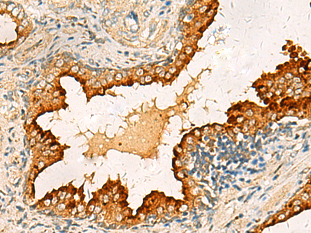 Immunohistochemistry of paraffin-embedded Human prost ate cancer tissue  using PDCL Polyclonal Antibody at dilution of 1:40(×200)