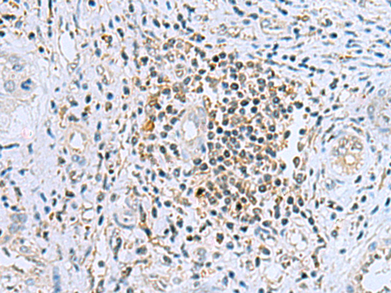 Immunohistochemistry of paraffin-embedded Human liver cancer tissue  using DHRS7B Polyclonal Antibody at dilution of 1:80(×200)