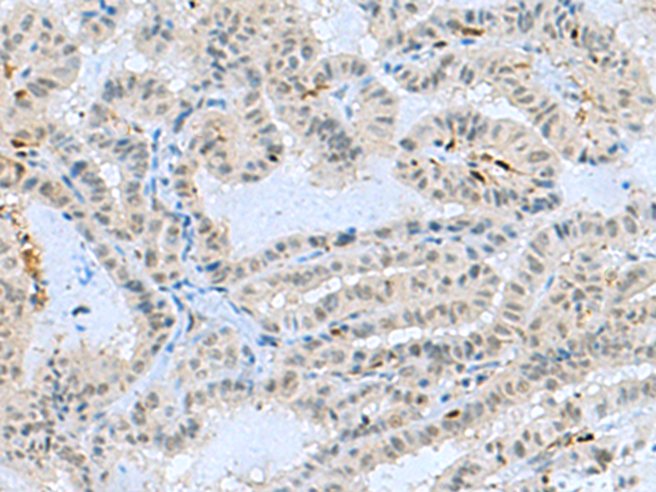 Immunohistochemistry of paraffin-embedded Human thyroid cancer tissue  using TCF19 Polyclonal Antibody at dilution of 1:60(×200)