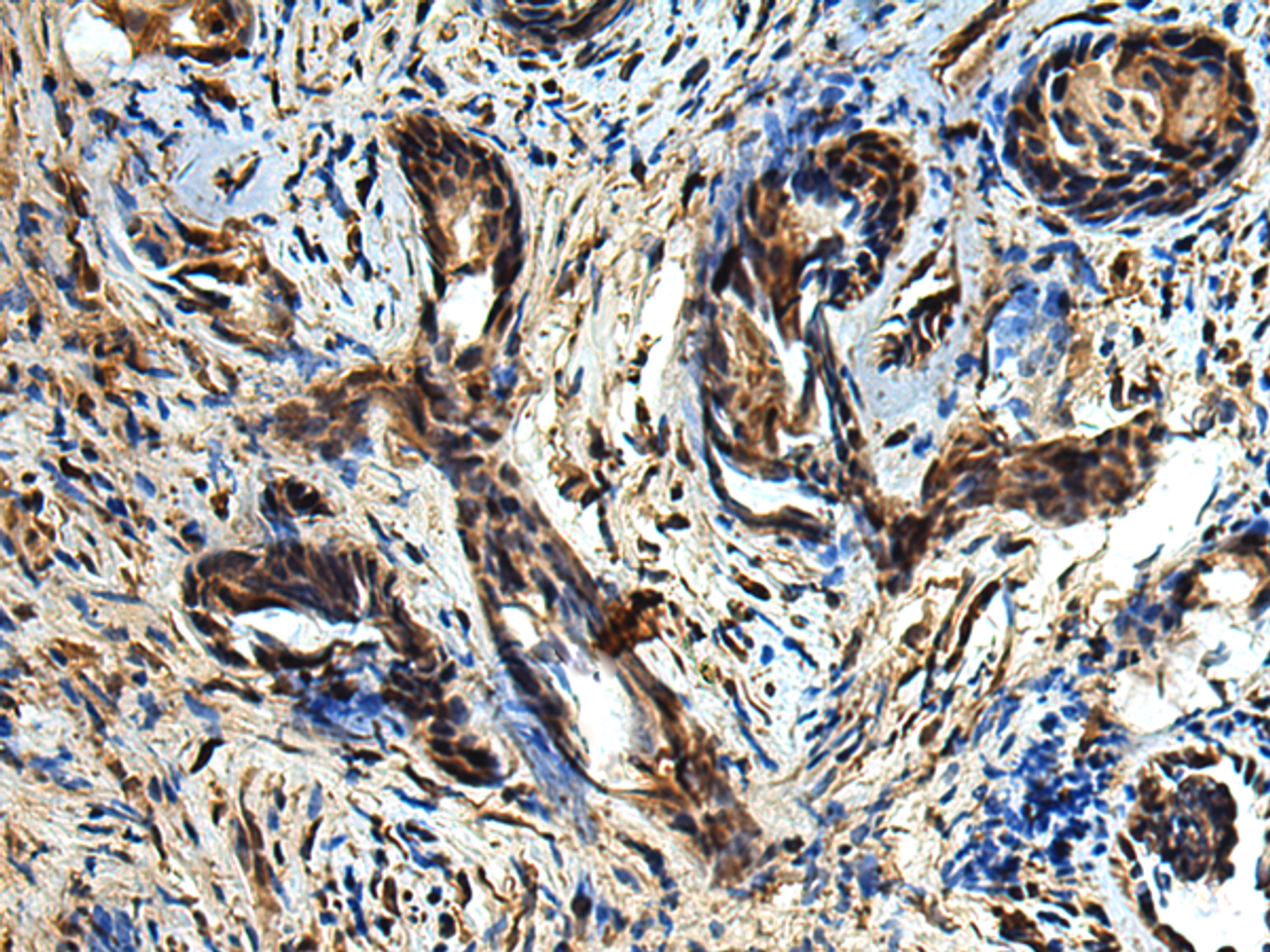 Immunohistochemistry of paraffin-embedded Human prost at e cancer tissue  using TBCC Polyclonal Antibody at dilution of 1:80(×200)