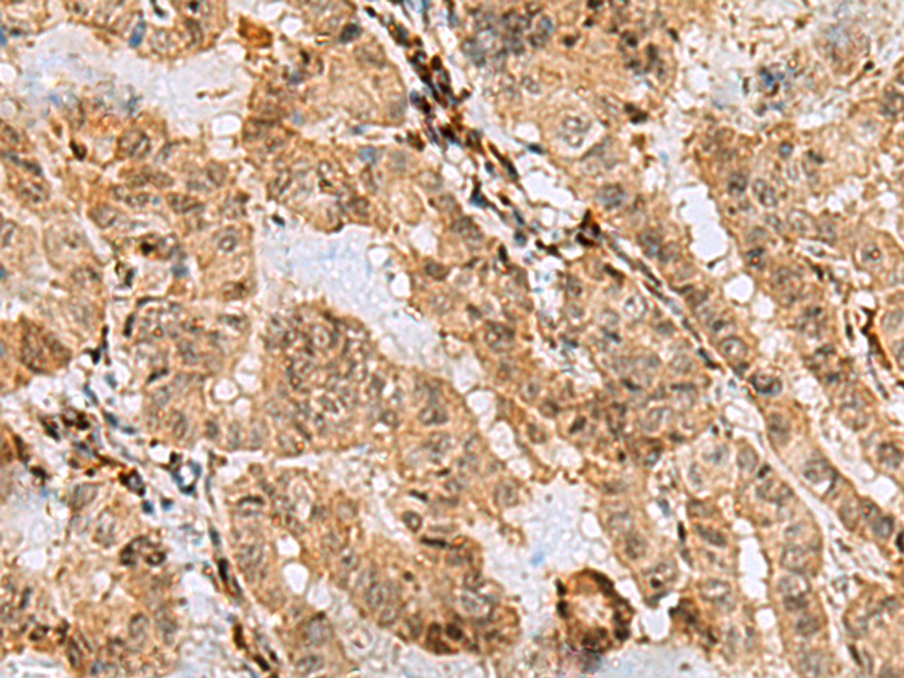 Immunohistochemistry of paraffin-embedded Human thyroid cancer tissue  using ASNA1 Polyclonal Antibody at dilution of 1:70(×200)