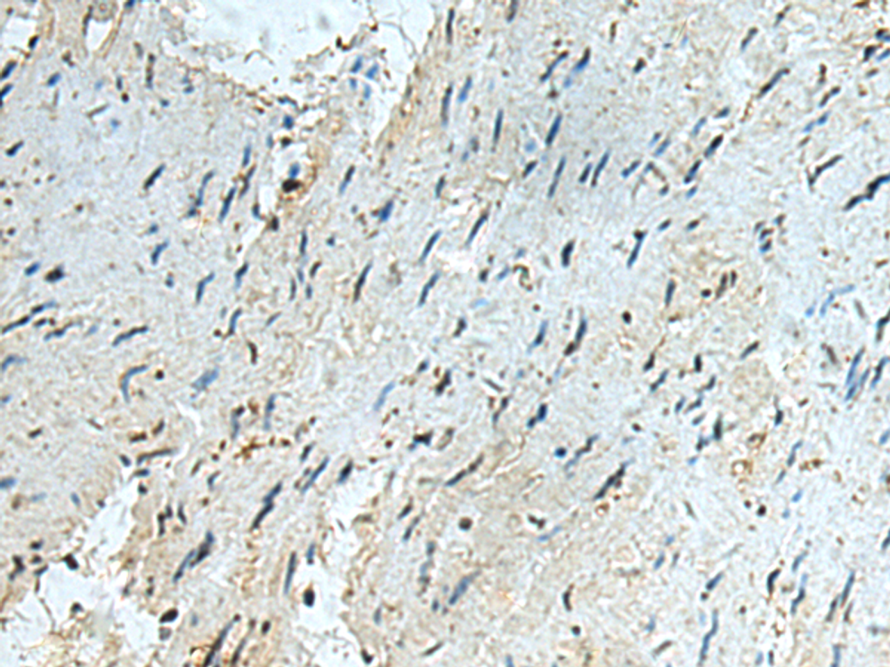 Immunohistochemistry of paraffin-embedded Human gastric cancer tissue  using RAPSN Polyclonal Antibody at dilution of 1:40(×200)