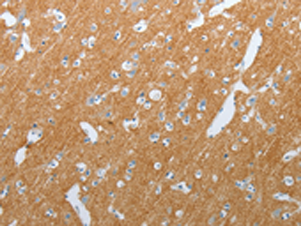 Immunohistochemistry of paraffin-embedded Human brain tissue  using SLC17A7 Polyclonal Antibody at dilution of 1:200(×200)