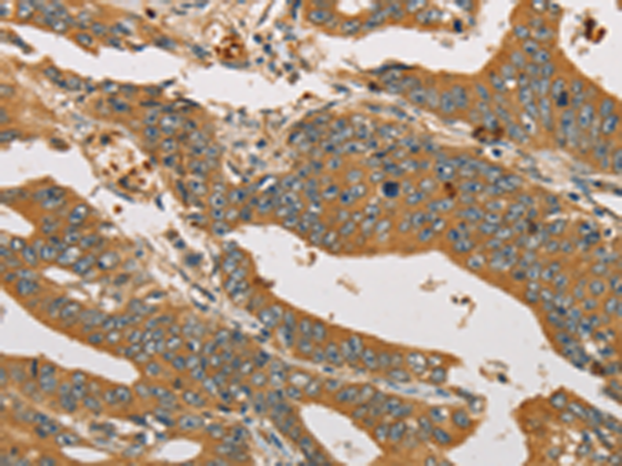 Immunohistochemistry of paraffin-embedded Human gastric cancer tissue  using XPR1 Polyclonal Antibody at dilution of 1:45(×200)
