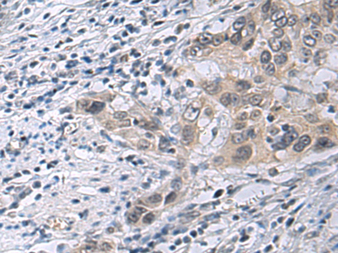 Immunohistochemistry of paraffin-embedded Human esophagus cancer tissue  using IRS4 Polyclonal Antibody at dilution of 1:45(×200)