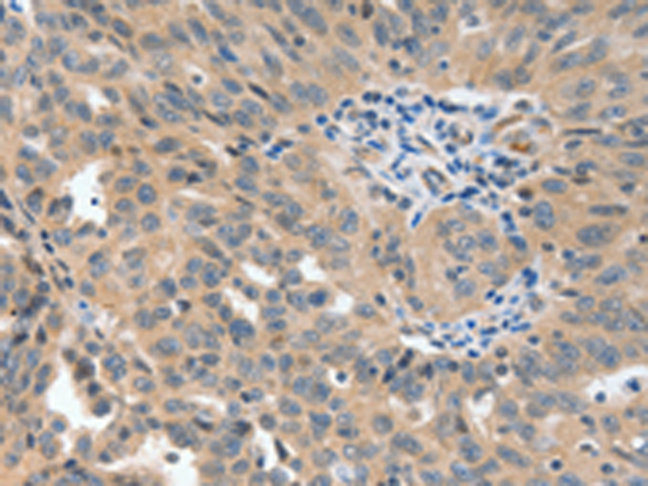 Immunohistochemistry of paraffin-embedded Human ovarian cancer tissue  using P2RY6 Polyclonal Antibody at dilution of 1:40(×200)