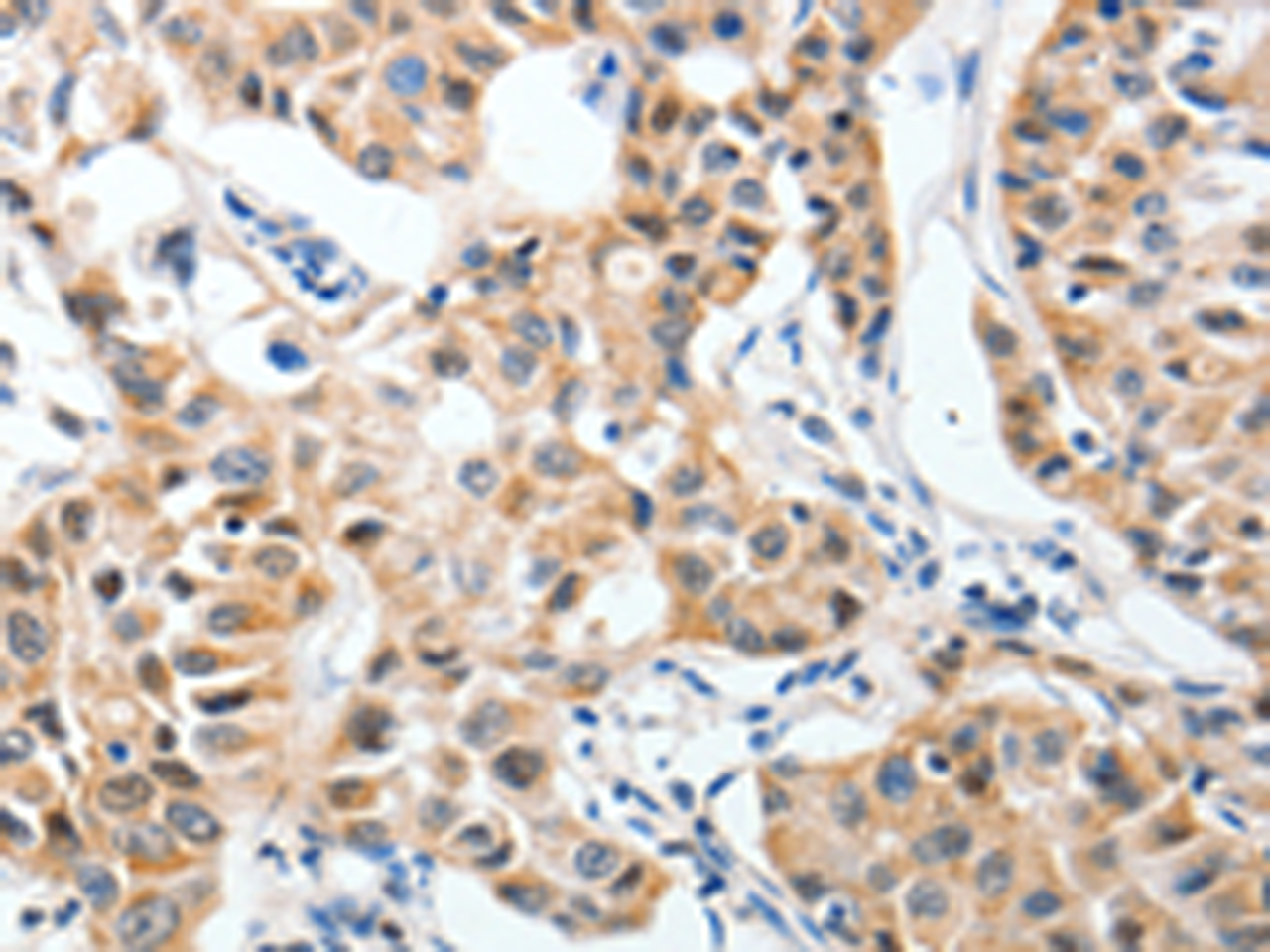 Immunohistochemistry of paraffin-embedded Human lung cancer tissue  using P2RY6 Polyclonal Antibody at dilution of 1:40(×200)