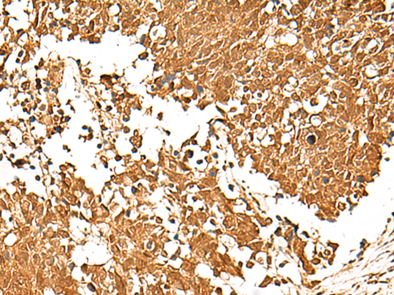 Immunohistochemistry of paraffin-embedded Human lung cancer tissue  using TCF7 Polyclonal Antibody at dilution of 1:30(×200)