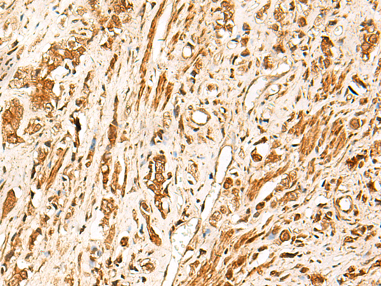 Immunohistochemistry of paraffin-embedded Human prost ate cancer tissue  using TCF7 Polyclonal Antibody at dilution of 1:30(×200)