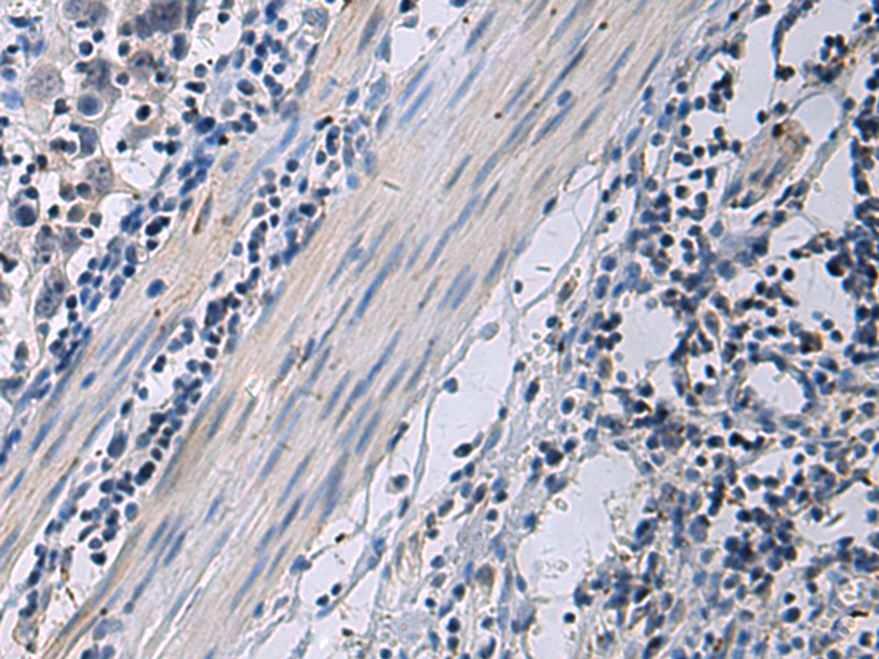 Immunohistochemistry of paraffin-embedded Human esophagus cancer tissue  using ANGPTL2 Polyclonal Antibody at dilution of 1:55(×200)