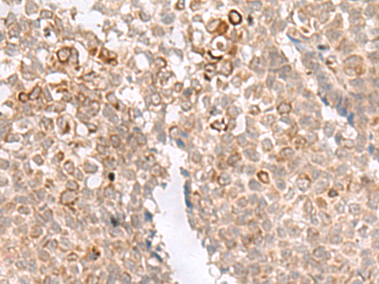 Immunohistochemistry of paraffin-embedded Human ovarian cancer tissue  using MCAM Polyclonal Antibody at dilution of 1:40(×200)