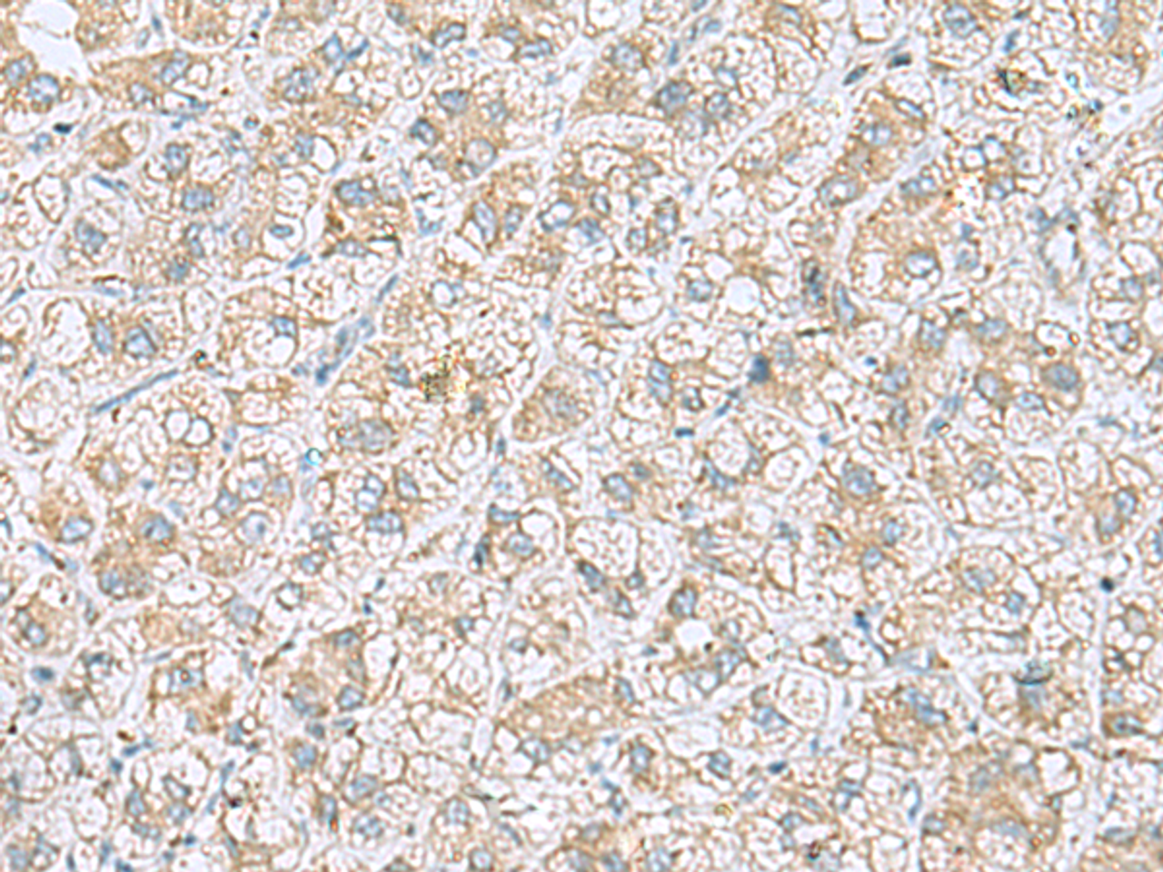 Immunohistochemistry of paraffin-embedded Human liver cancer tissue  using NDRG4 Polyclonal Antibody at dilution of 1:45(×200)