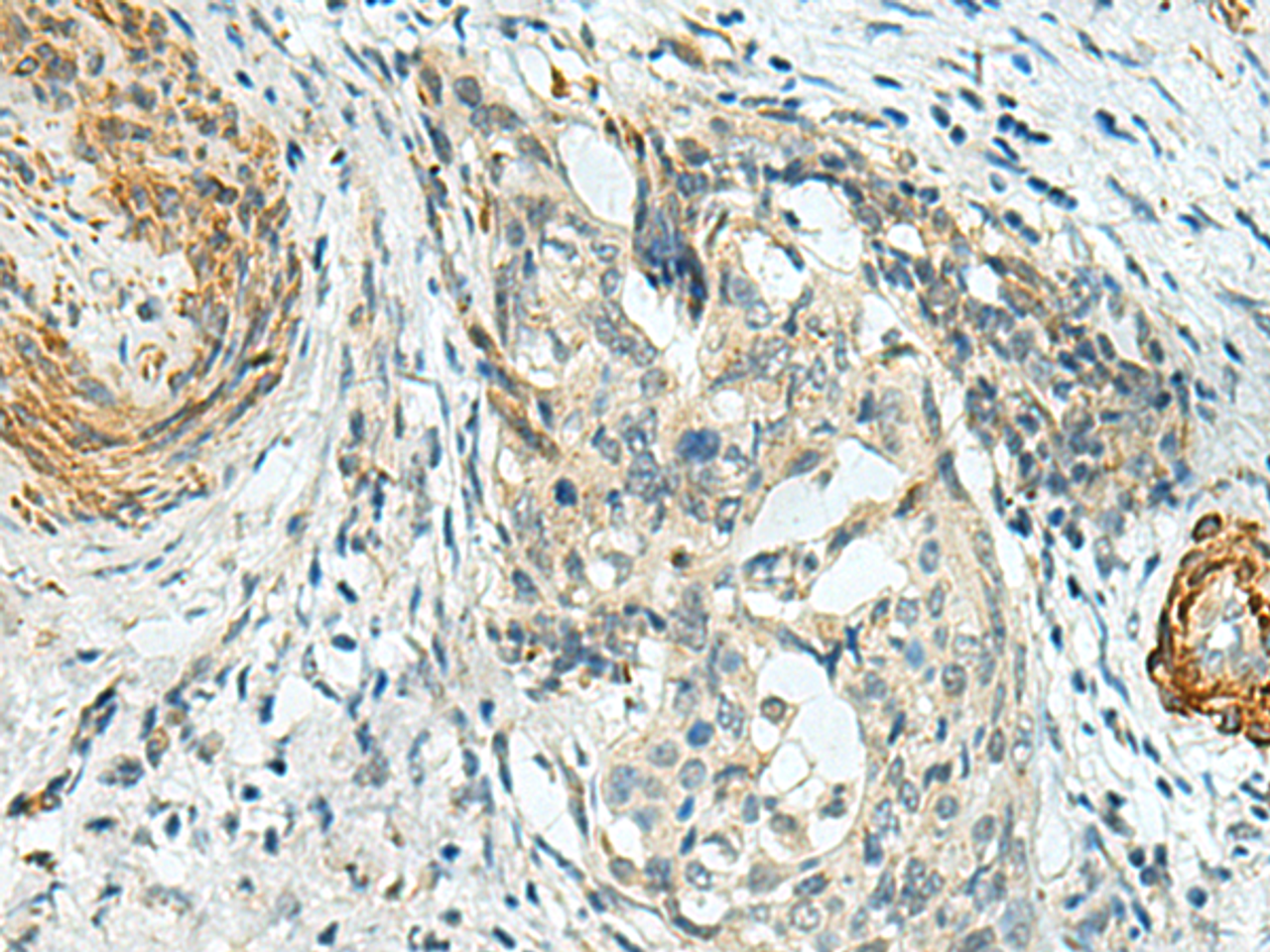 Immunohistochemistry of paraffin-embedded Human cervical cancer tissue  using PLPPR5 Polyclonal Antibody at dilution of 1:120(×200)