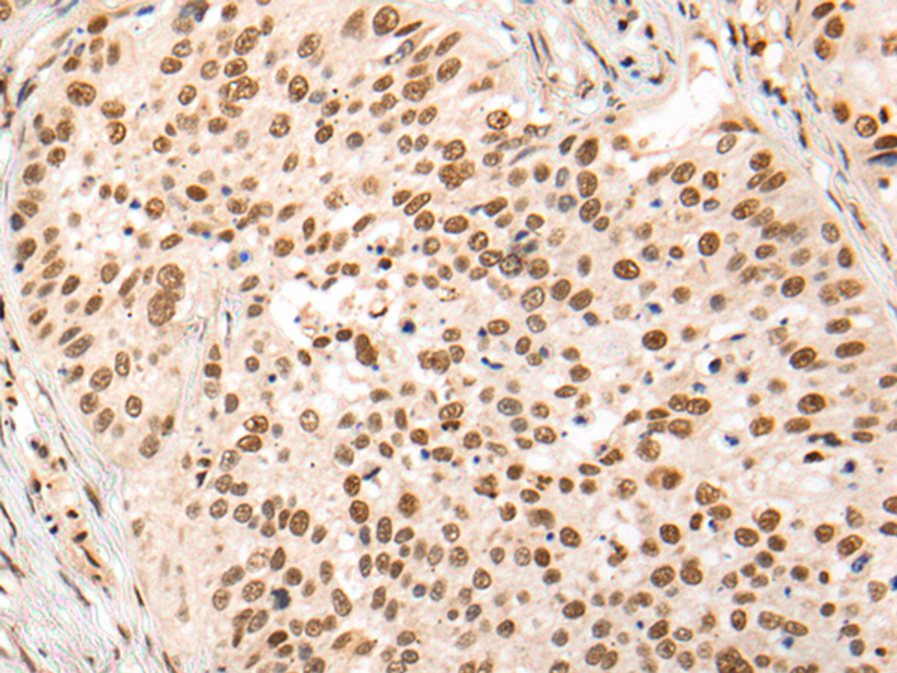 Immunohistochemistry of paraffin-embedded Human lung cancer tissue  using HOXA7 Polyclonal Antibody at dilution of 1:70(×200)