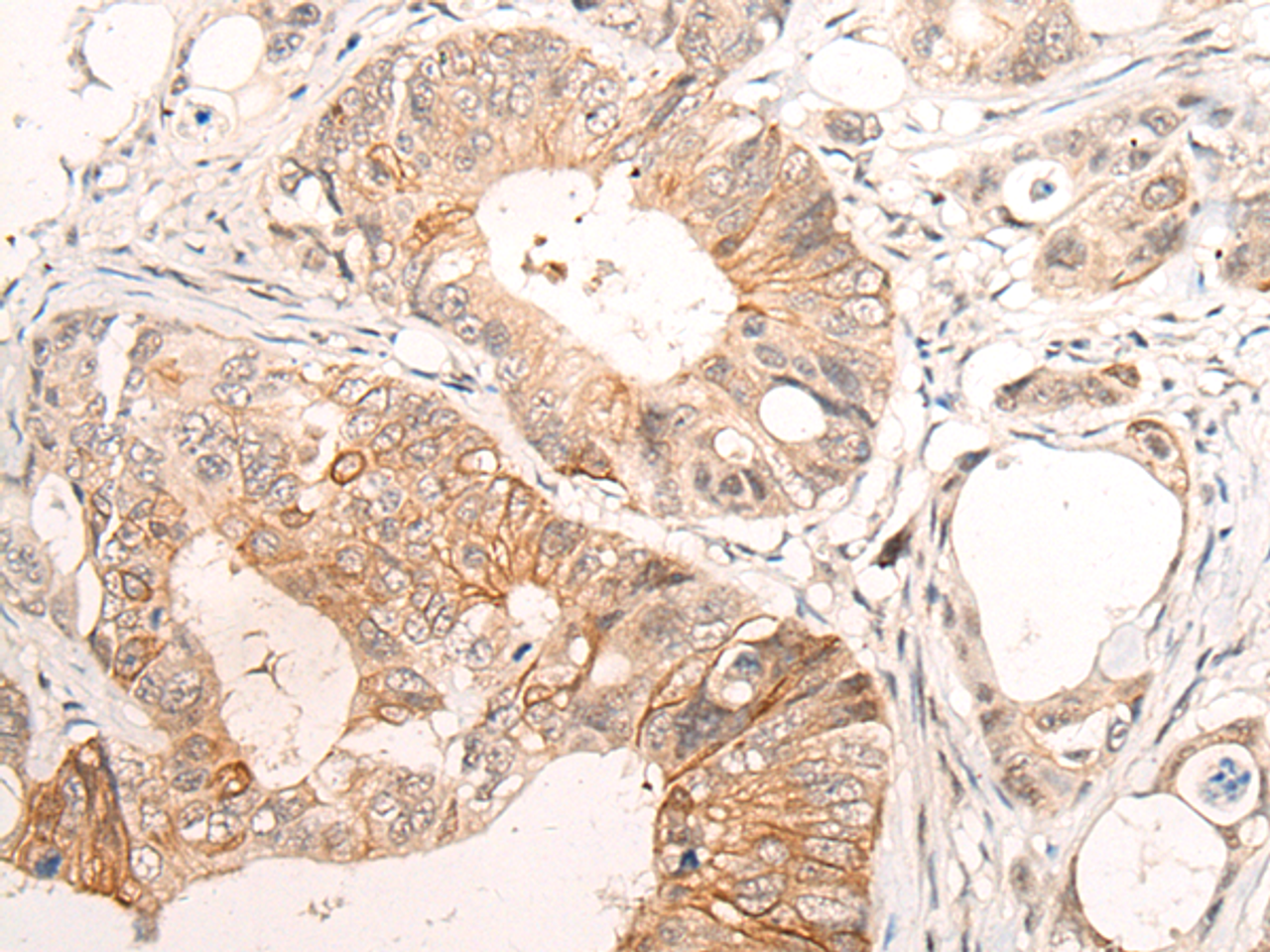 Immunohistochemistry of paraffin-embedded Human colorectal cancer tissue  using HTRA1  Polyclonal Antibody at dilution of 1:55(×200)