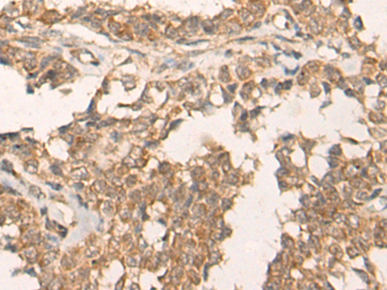 Immunohistochemistry of paraffin-embedded Human ovarian cancer tissue  using ATR Polyclonal Antibody at dilution of 1:60(×200)