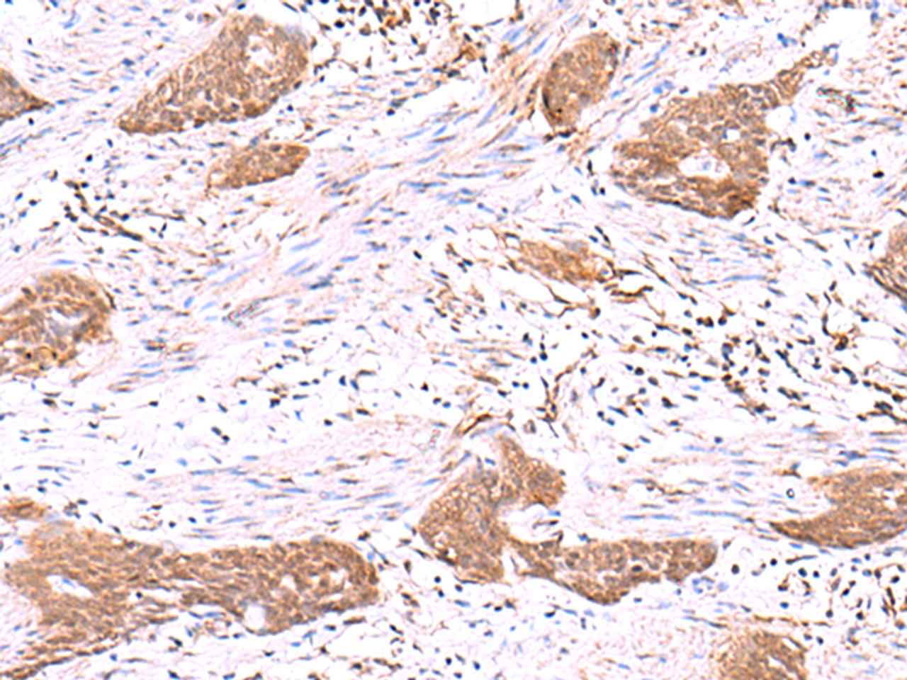 Immunohistochemistry of paraffin-embedded Human esophagus cancer tissue  using SASH1 Polyclonal Antibody at dilution of 1:30(×200)