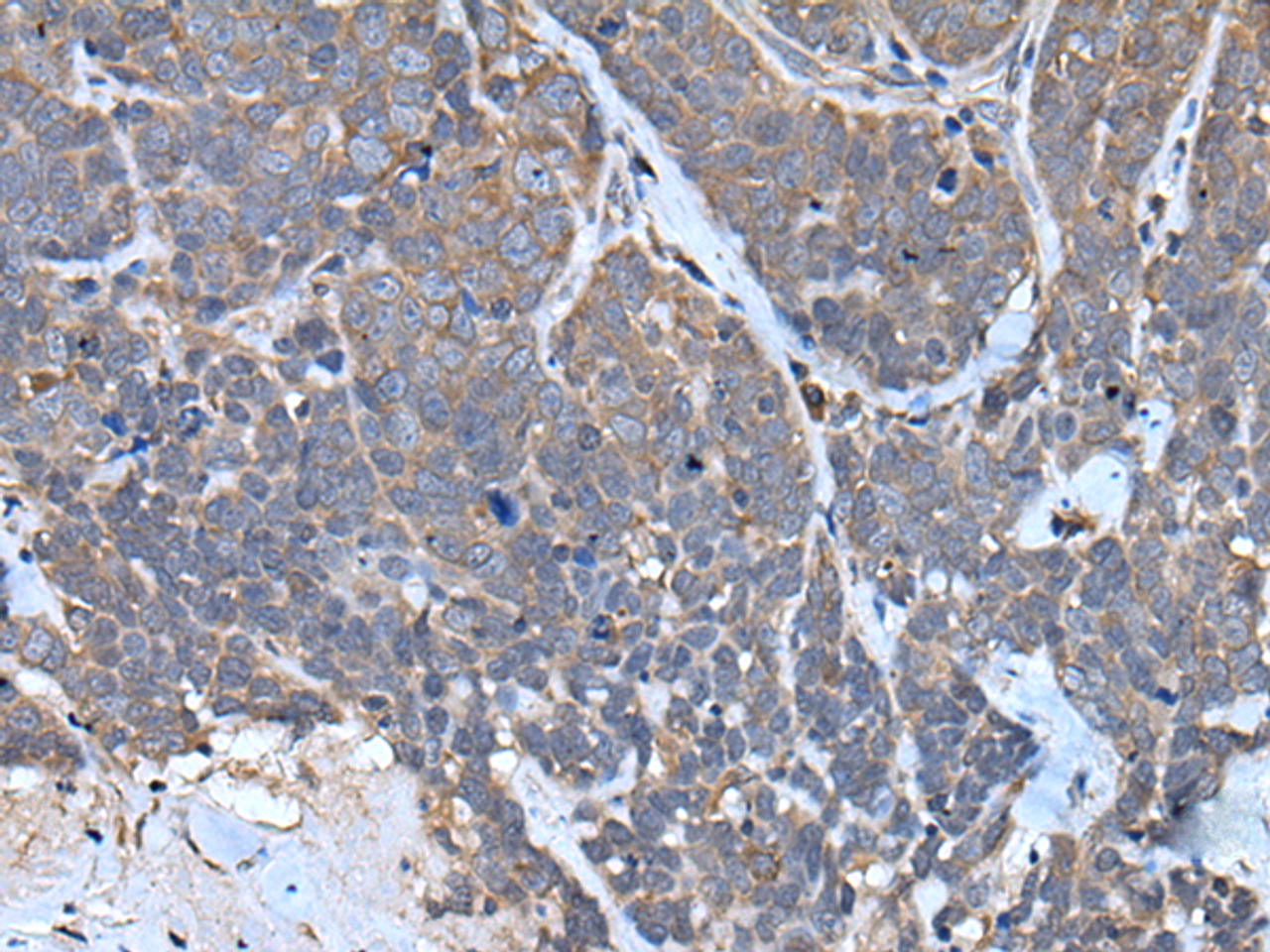 Immunohistochemistry of paraffin-embedded Human thyroid cancer tissue  using TNMD Polyclonal Antibody at dilution of 1:40(×200)