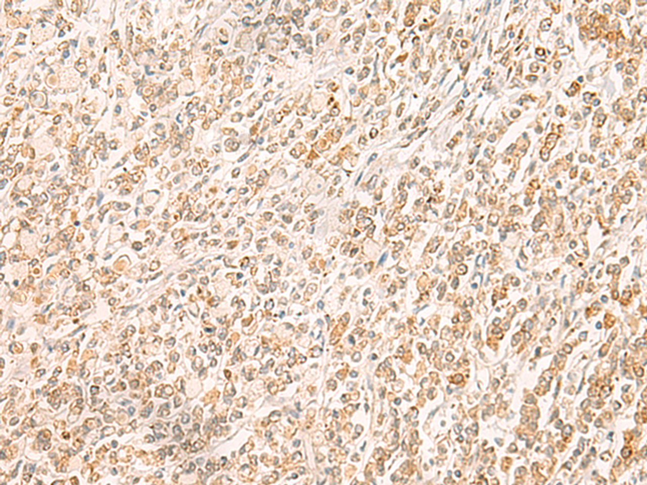 Immunohistochemistry of paraffin-embedded Human gastric cancer tissue  using MYCT1 Polyclonal Antibody at dilution of 1:35(×200)