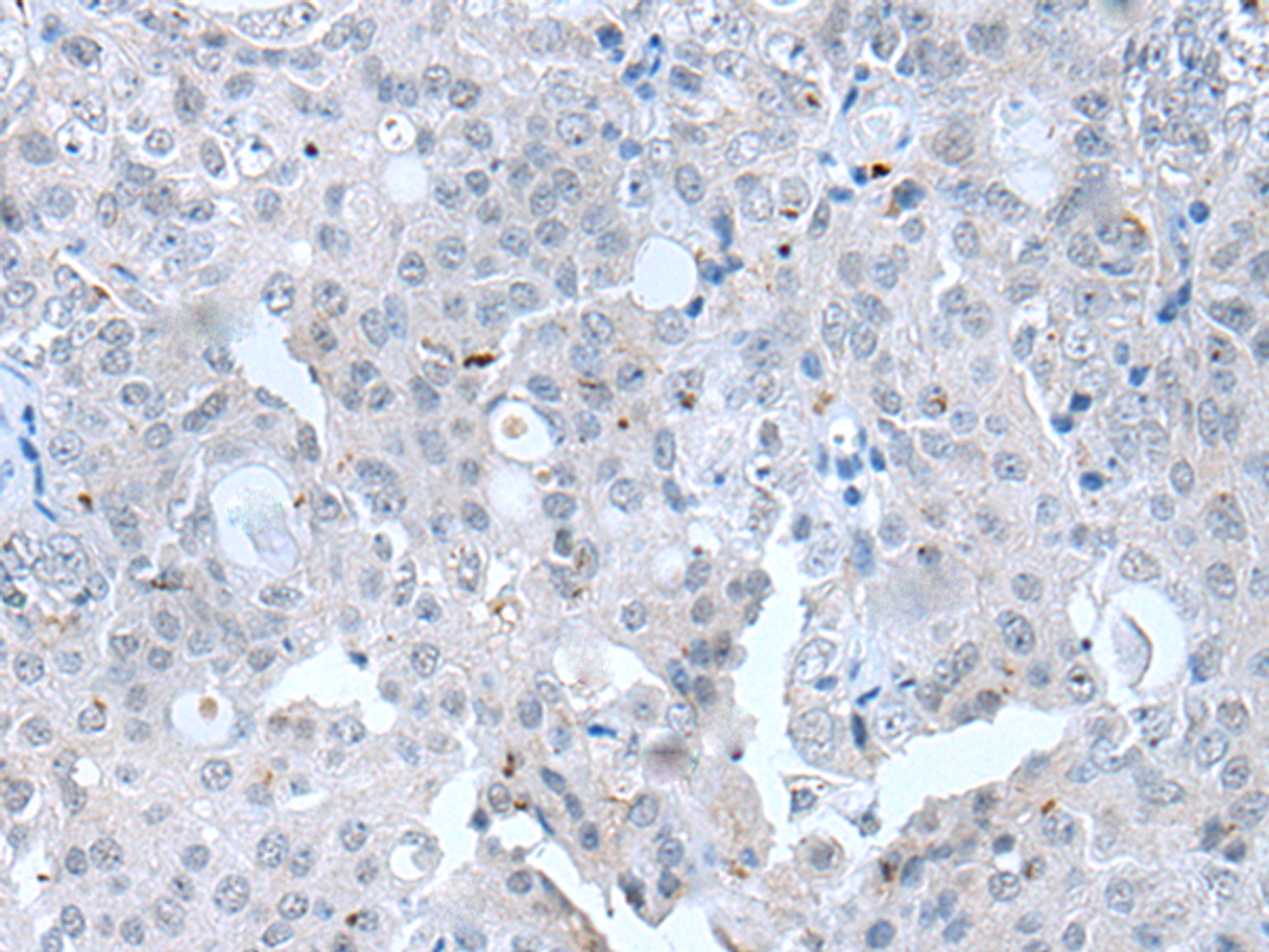 Immunohistochemistry of paraffin-embedded Human ovarian cancer tissue  using CLDN12 Polyclonal Antibody at dilution of 1:45(×200)