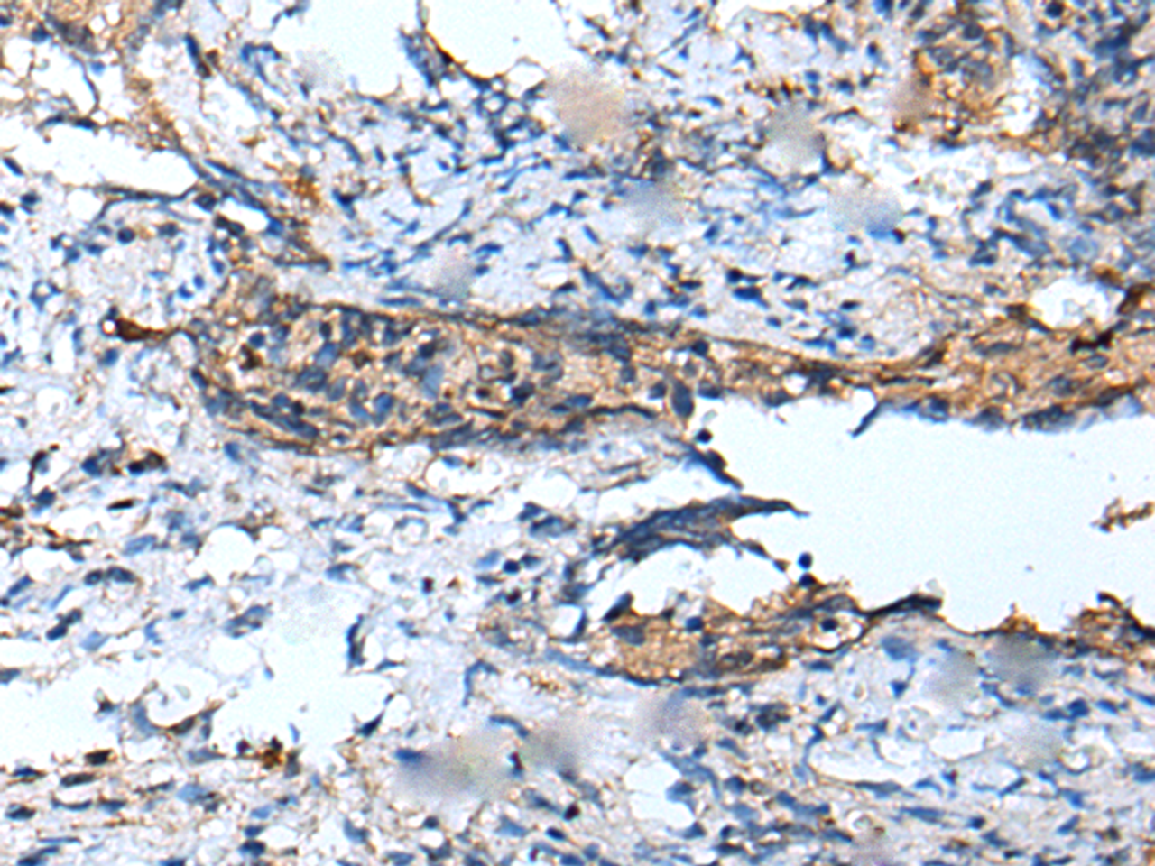 Immunohistochemistry of paraffin-embedded Human cervical cancer tissue  using DEFB104A Polyclonal Antibody at dilution of 1:50(×200)