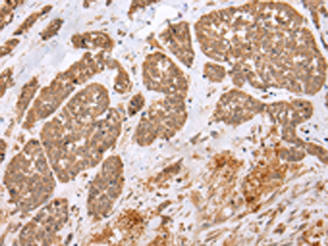 Immunohistochemistry of paraffin-embedded Human esophagus cancer tissue  using E2F5 Polyclonal Antibody at dilution of 1:25(×200)