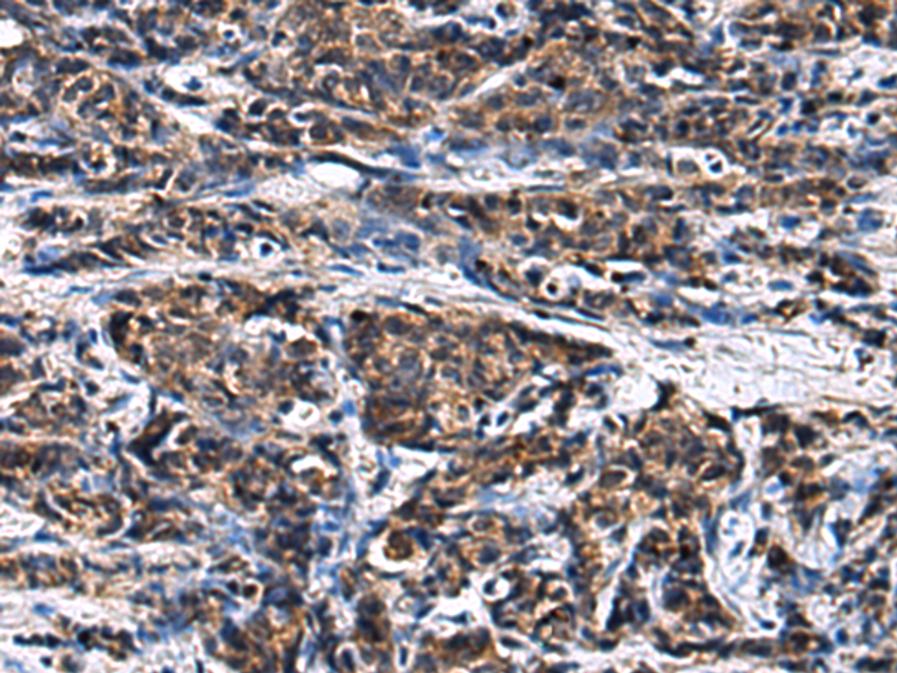 Immunohistochemistry of paraffin-embedded Human prost ate cancer tissue  using GANAB Polyclonal Antibody at dilution of 1:30(×200)