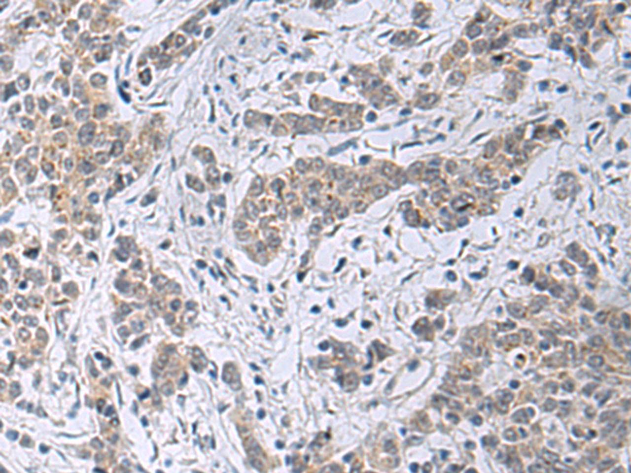 Immunohistochemistry of paraffin-embedded Human colorectal cancer tissue  using SLC4A3 Polyclonal Antibody at dilution of 1:35(×200)