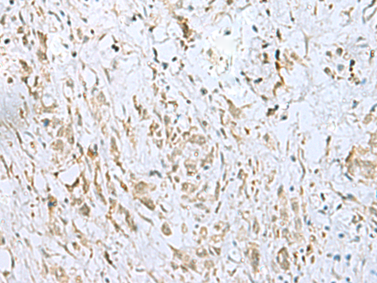 Immunohistochemistry of paraffin-embedded Human gastric cancer tissue  using ECT2 Polyclonal Antibody at dilution of 1:35(×200)