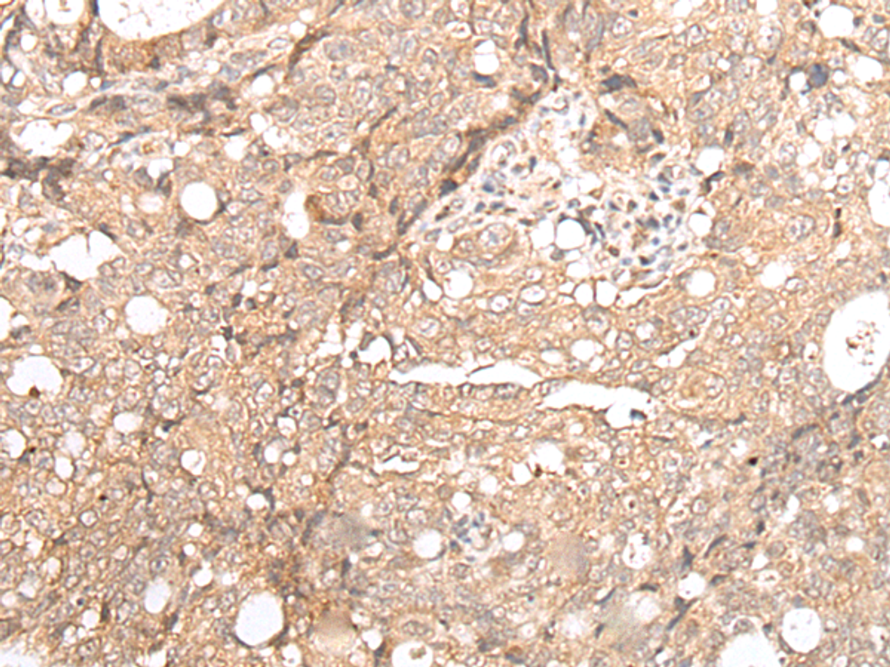 Immunohistochemistry of paraffin-embedded Human gastric cancer tissue  using FOXO4 Polyclonal Antibody at dilution of 1:70(×200)