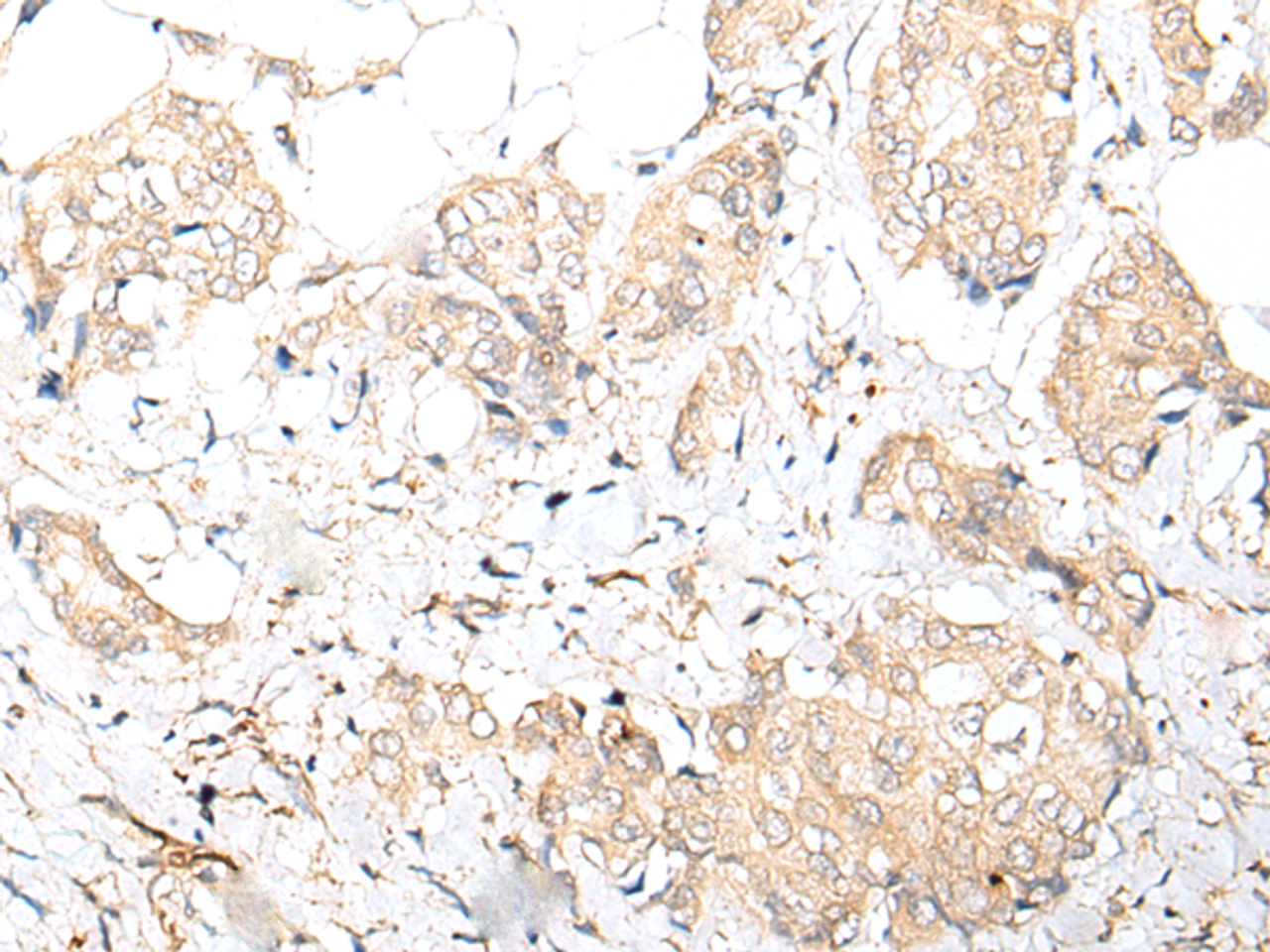 Immunohistochemistry of paraffin-embedded Human breast cancer tissue  using FOXO4 Polyclonal Antibody at dilution of 1:70(×200)