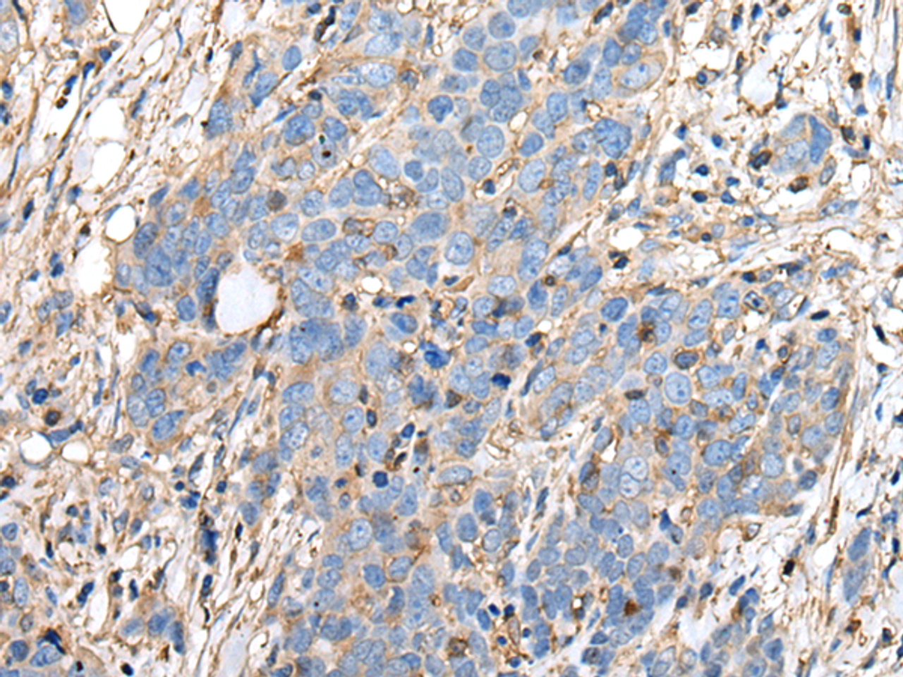 Immunohistochemistry of paraffin-embedded Human thyroid cancer tissue  using PLA2G16 Polyclonal Antibody at dilution of 1:40(×200)