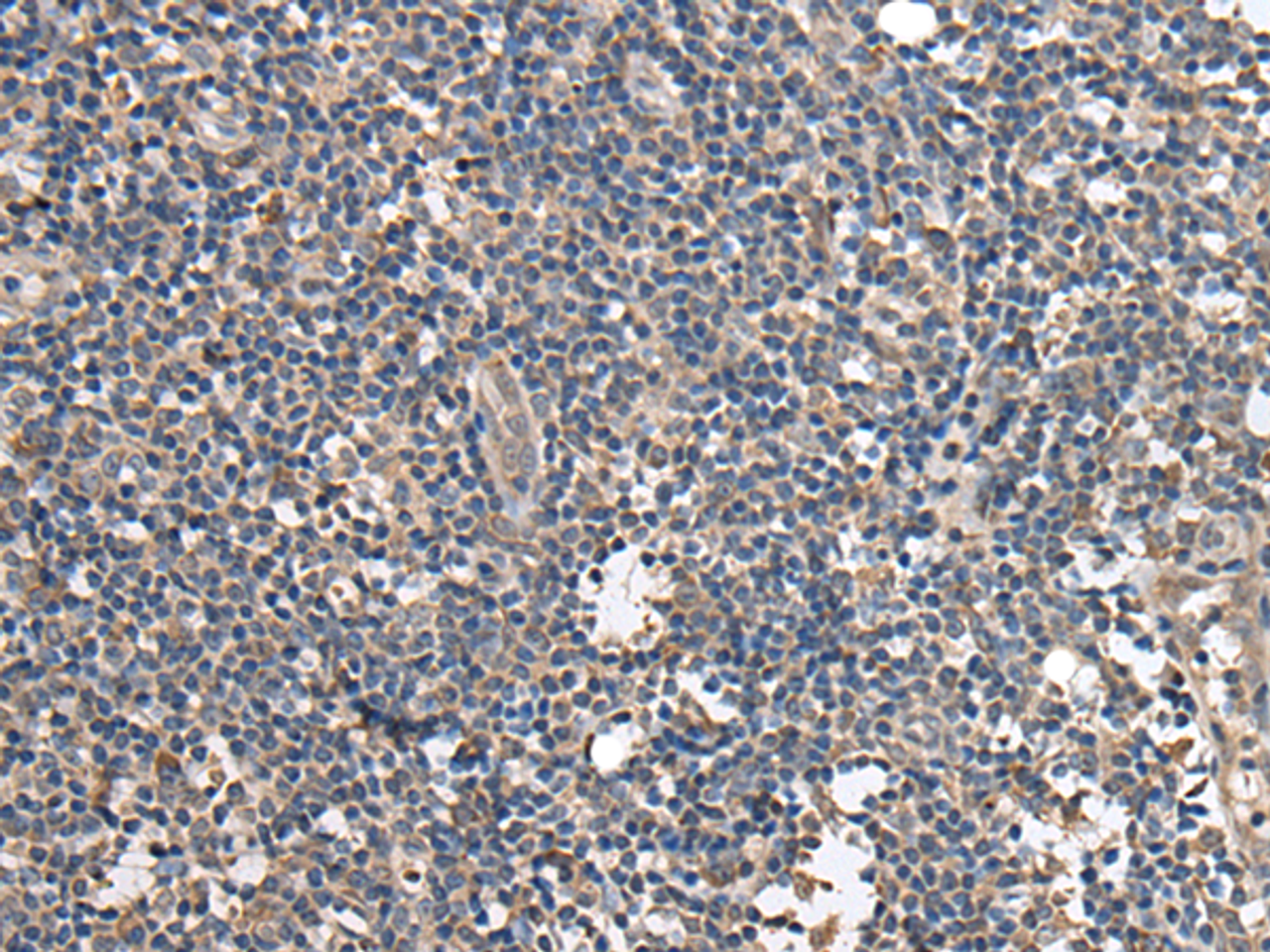 Immunohistochemistry of paraffin-embedded Human tonsil tissue  using BRI3BP Polyclonal Antibody at dilution of 1:35(×200)