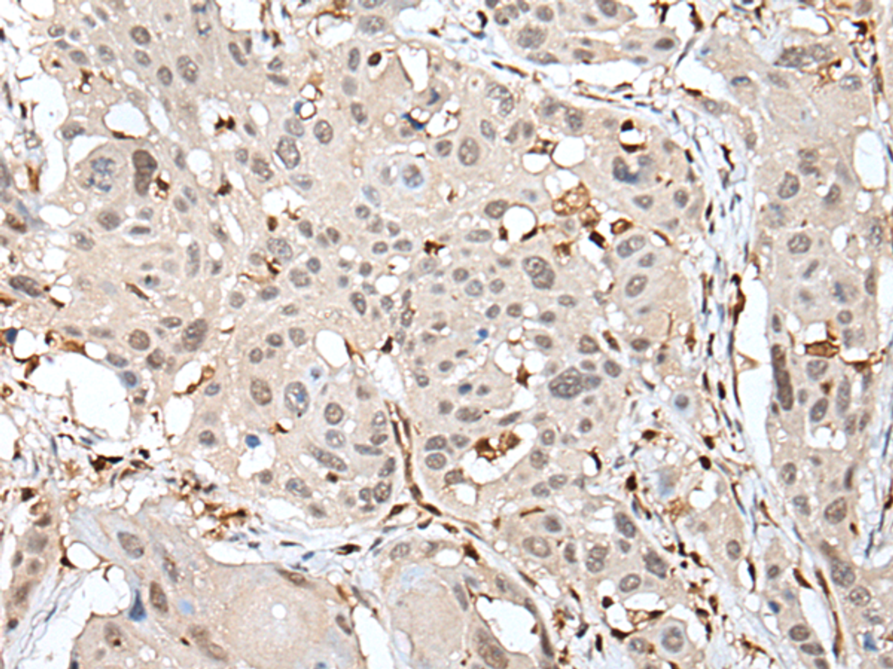 Immunohistochemistry of paraffin-embedded Human esophagus cancer tissue  using ARHGDIB Polyclonal Antibody at dilution of 1:35(×200)
