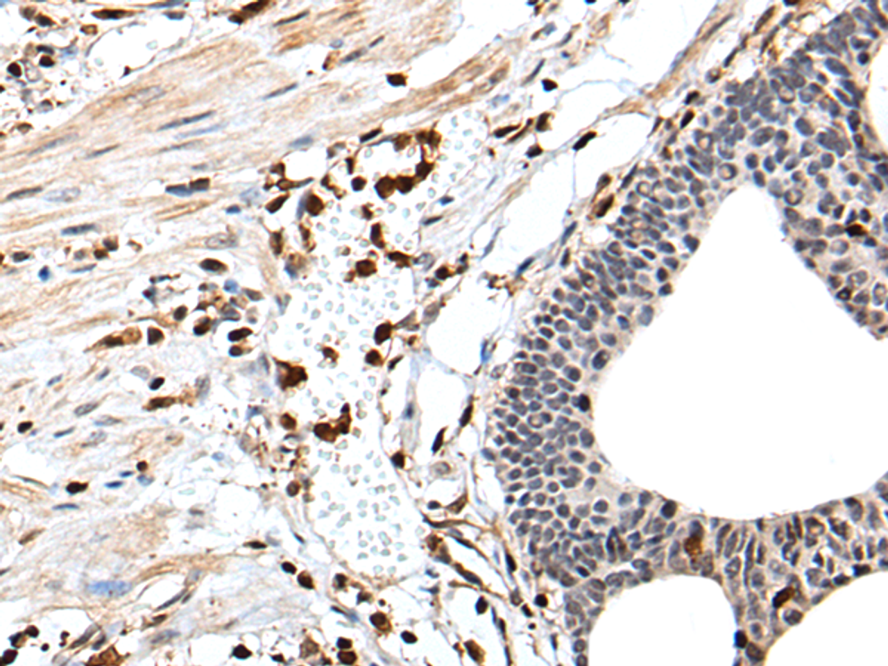 Immunohistochemistry of paraffin-embedded Human gastric cancer tissue  using ARHGDIB Polyclonal Antibody at dilution of 1:35(×200)