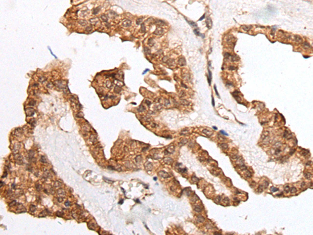 Immunohistochemistry of paraffin-embedded Human thyroid cancer tissue  using HOXB9 Polyclonal Antibody at dilution of 1:45(×200)