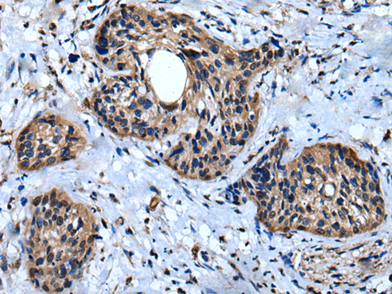 Immunohistochemistry of paraffin-embedded Human cervical cancer tissue  using IQGAP1 Polyclonal Antibody at dilution of 1:30(×200)